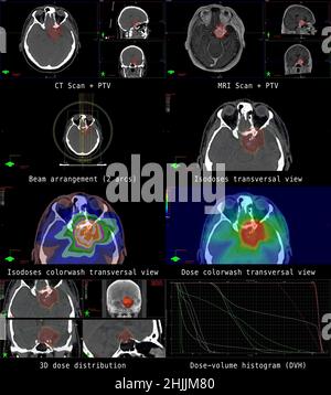 Illustration of a modern radiation plan for cancer therapy of a patient with a brain tumor (meningioma). Stock Photo