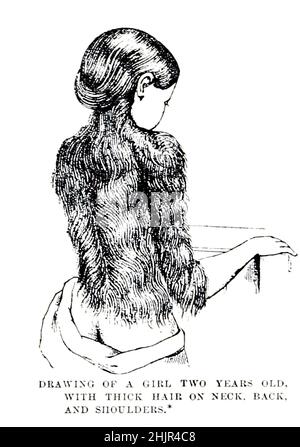 Drawing of a Girl Two Years Old, with Thick hair on her Neck and Shoulders [hypertrichosis an abnormal amount of hair growth over the body]. from the book '  The living races of mankind ' Vol 1 by Henry Neville Hutchinson,, editors John Walter Gregory, and Richard Lydekker, Publisher: London,  Hutchinson & co 1901 Stock Photo