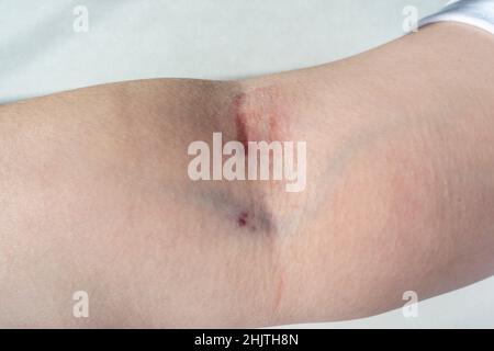 Close up view of a caucasian female's arm after having blood drawn from the same vein twice in one day, causing severe skin irritation Stock Photo