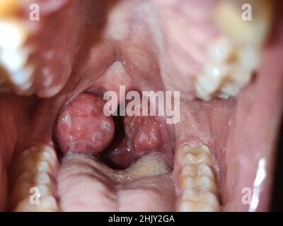 retromolar trigone swollen