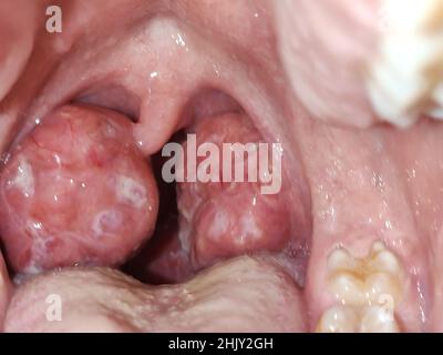 Tonsils. Swollen tonsils with plaque due to acute anguineous. Horizontal photography. Stock Photo