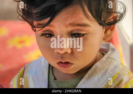 An east Indian baby boy with chicken pox rashes on his face and neck. Stock Photo