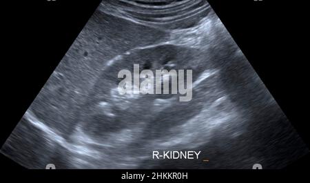 Healthy kidney, ultrasound scan Stock Photo