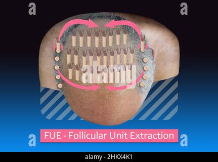 Methods of hair transplantation FUT and FUE fue with transplant as infographic element of illustration. Human alopecia or hair loss problem on adult senior or mature man. Before and after concept Stock Photo