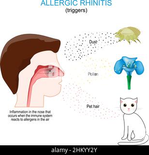 Allergic rhinitis. Inflammation in the nose that occurs when the immune system reacts to allergens in the air. triggers: dust, pollen, and pet hair Stock Vector