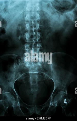 X Ray image of Spine and pelvis of human body Stock Photo - Alamy