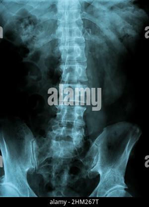 X-ray of the pelvis and spinal column Stock Photo - Alamy