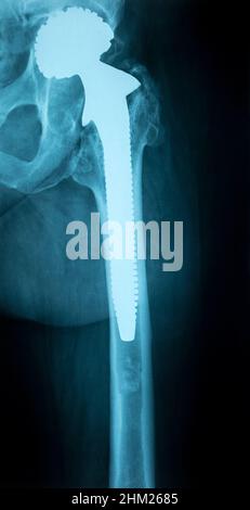 X-Ray Image of a Human Chest with Artificial hip joint Stock Photo