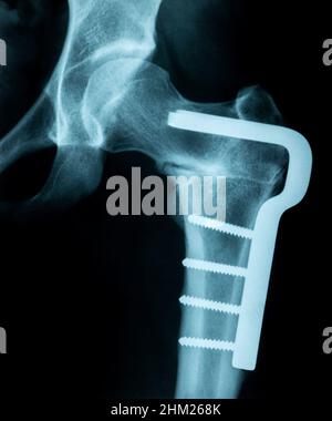 X-Ray Image of a broken pelvis/hip with metal pins holding it together Stock Photo
