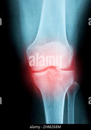 Medical x-ray knee joint image with arthritis ( Gout , Rheumatoid ...