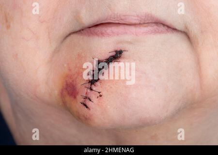 Horizontal shot of a post surgical suture between her lower lip and her chin following skin cancer surgery. Stock Photo