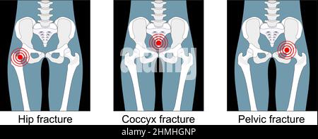 hip fracture, break of the sacrum or pelvis, pain in the coccyx. front view. Set icons. black and white. Flat vector illustration. Stock Vector