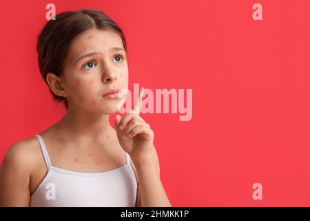 Little girl ill with chickenpox pointing at something on red background Stock Photo