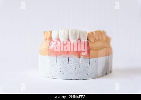 Lower jaw denture made of ceramics located on plaster model Stock Photo