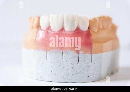 Lower jaw denture made of ceramics located on plaster model isolated Stock Photo