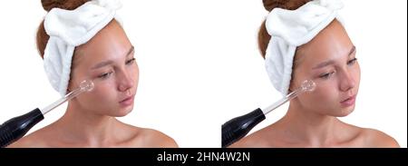 Collage with isolated portrait of caucasian young woman without make up with acne and without acne and band on head, holding darsonval on face looking Stock Photo