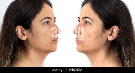Before after photo up photo of woman with excessive amont of pimples on the face. Concept of beauty and skin care. Stock Photo