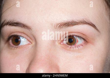 Macro human eyes, burst capillaries, bruising on white of the eye. Red spot after childbirth in a woman in labor, close-up. Stock Photo