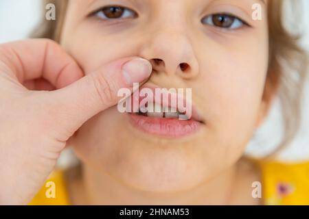 The child has stomatitis on the lip. Selective focus. Kid. Stock Photo