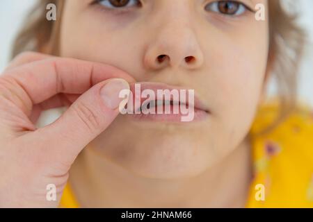 The child has stomatitis on the lip. Selective focus. Kid. Stock Photo