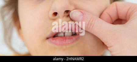The child has stomatitis on the lip. Selective focus. Kid. Stock Photo