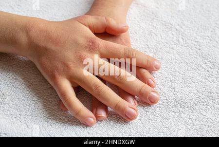 Red spots on the skin of the child's hands.children's allergy.selective focus Stock Photo