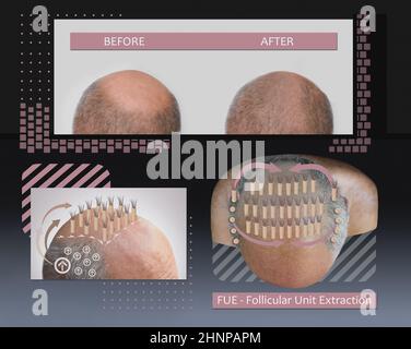 Methods of hair transplantation fut vs fue with infographic elements of illustration. Stock Photo