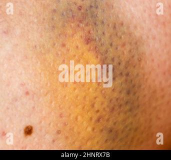 Large bruise hematoma on the humans leg on the skin in different colors Stock Photo