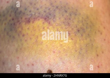 Large bruise hematoma on the humans leg on the skin in different colors Stock Photo