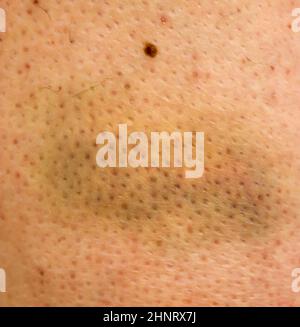 Large bruise hematoma on the humans leg on the skin in different colors Stock Photo