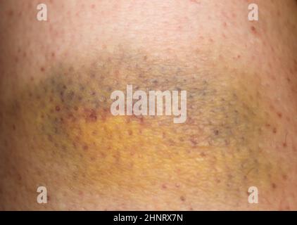 Large bruise hematoma on the humans leg on the skin in different colors Stock Photo