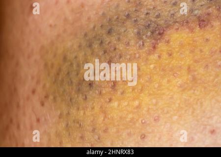 Large bruise hematoma on the humans leg on the skin in different colors Stock Photo