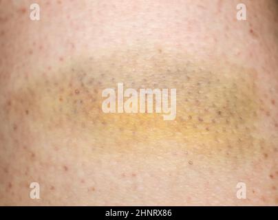 Large bruise hematoma on the humans leg on the skin in different colors Stock Photo