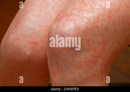 Red spots on skin during eczema dermatitis or other medical Stock Alamy