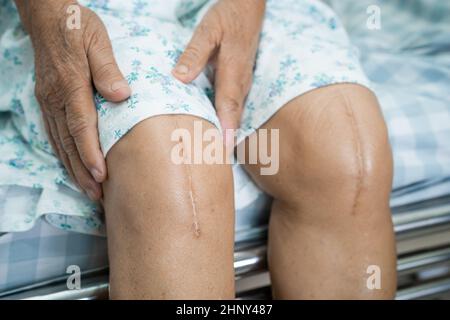 Asian senior or elderly old lady woman patient show her scars surgical total knee joint replacement Suture wound surgery arthroplasty on bed in nursin Stock Photo