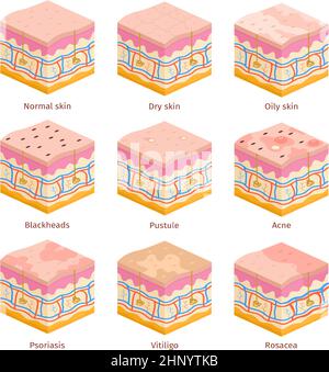 vitiligo and normal skin cross-section of human skin layers structure ...