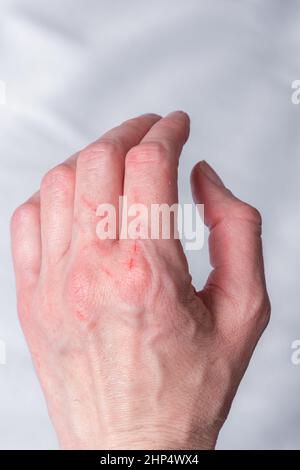 cat scratch injury on man foot skin Stock Photo - Alamy