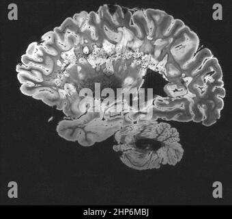 This is a pseudo-colored image of high-resolution gradient-echo MRI scan of a fixed cerebral hemisphere from a person with multiple sclerosis. Stock Photo