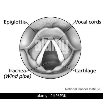 A top view of the larynx (seen with a mirror). The epiglottis, vocal cords, trachea, and cartilage are labeled ca.  2003 Stock Photo