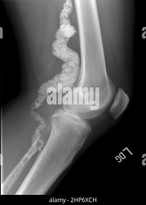 A knee x-ray of a patient with ACDC, a rare calcification disorder, reveals calcification in the main artery supplying blood to the lower leg ca.  January 21 2011 Stock Photo