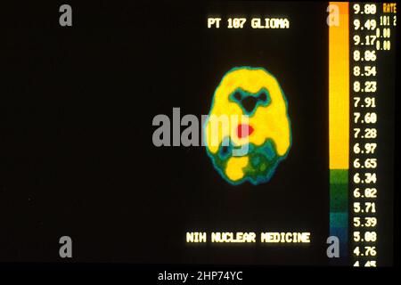 PET Brain Scan, Malignant Tumor Stock Photo - Alamy