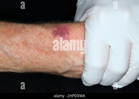 Purpura, senile purpura Stock Photo