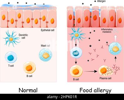 food allergy is an abnormal immune response to food. Cell of normal Epithelium and Food allergy. development of an allergic reaction from allergens Stock Vector