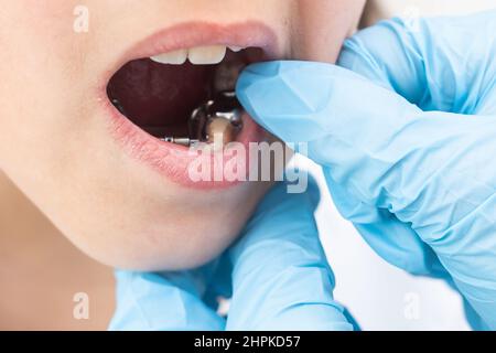 Girl putting on medical braces for orthodontic treatment over white. Stock Photo