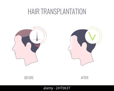 Hair transplantation in women, conceptual illustration Stock Photo