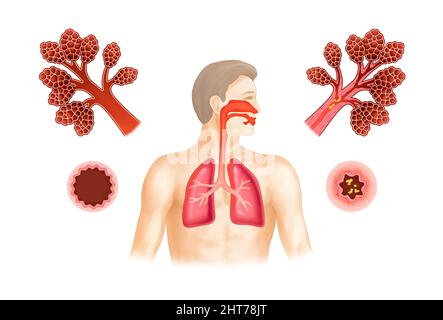 A realistic illustration of asthma and human anatomy Stock Photo