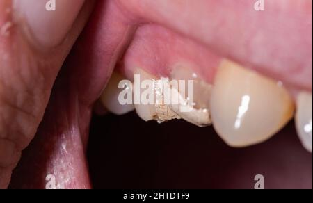 Tooth with temporary filling for nerve destruction and pulpitis treatment. Stomatology Stock Photo