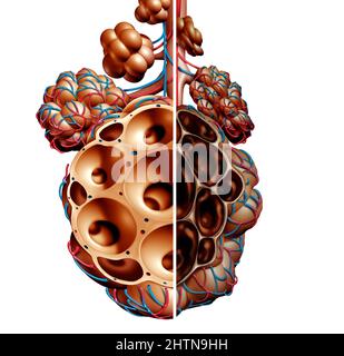 Emphysema as shortness of breath, lung disorder as a COPD illness and Chronic obstructive pulmonary disease concept as bronchioles and alveoli Stock Photo