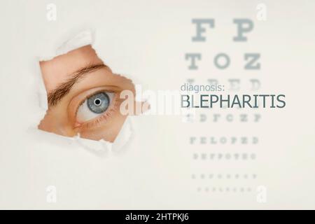 Blepharitis disease poster with eye test and blue eye on left. Studio grey background Stock Photo