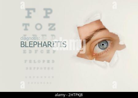 Blepharitis disease poster with eye test and blue eye on  right. Studio grey background Stock Photo